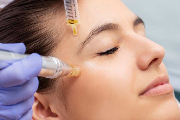 Microneedling Gesicht